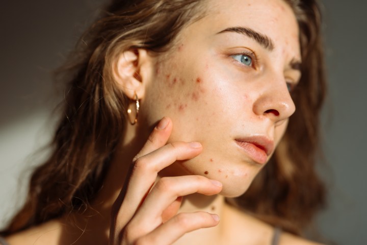Cuida tu piel con acné al seguir una rutina de maquillaje adecuada.