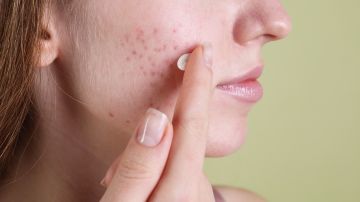 Los dermatólogos profesionales recomiendan la tretinoína en pieles con acné.