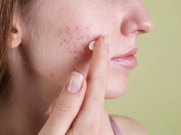 Los dermatólogos profesionales recomiendan la tretinoína en pieles con acné.