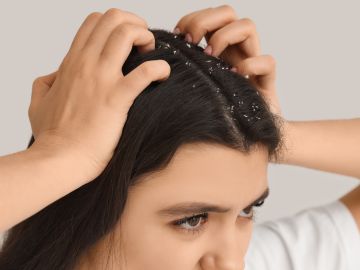 Los shampoos anti caspa son ideales para matar el hongo que ocasiona esta afección.
