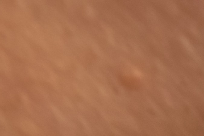 El cáncer de piel empieza a manifestarse con nuevos lunares.