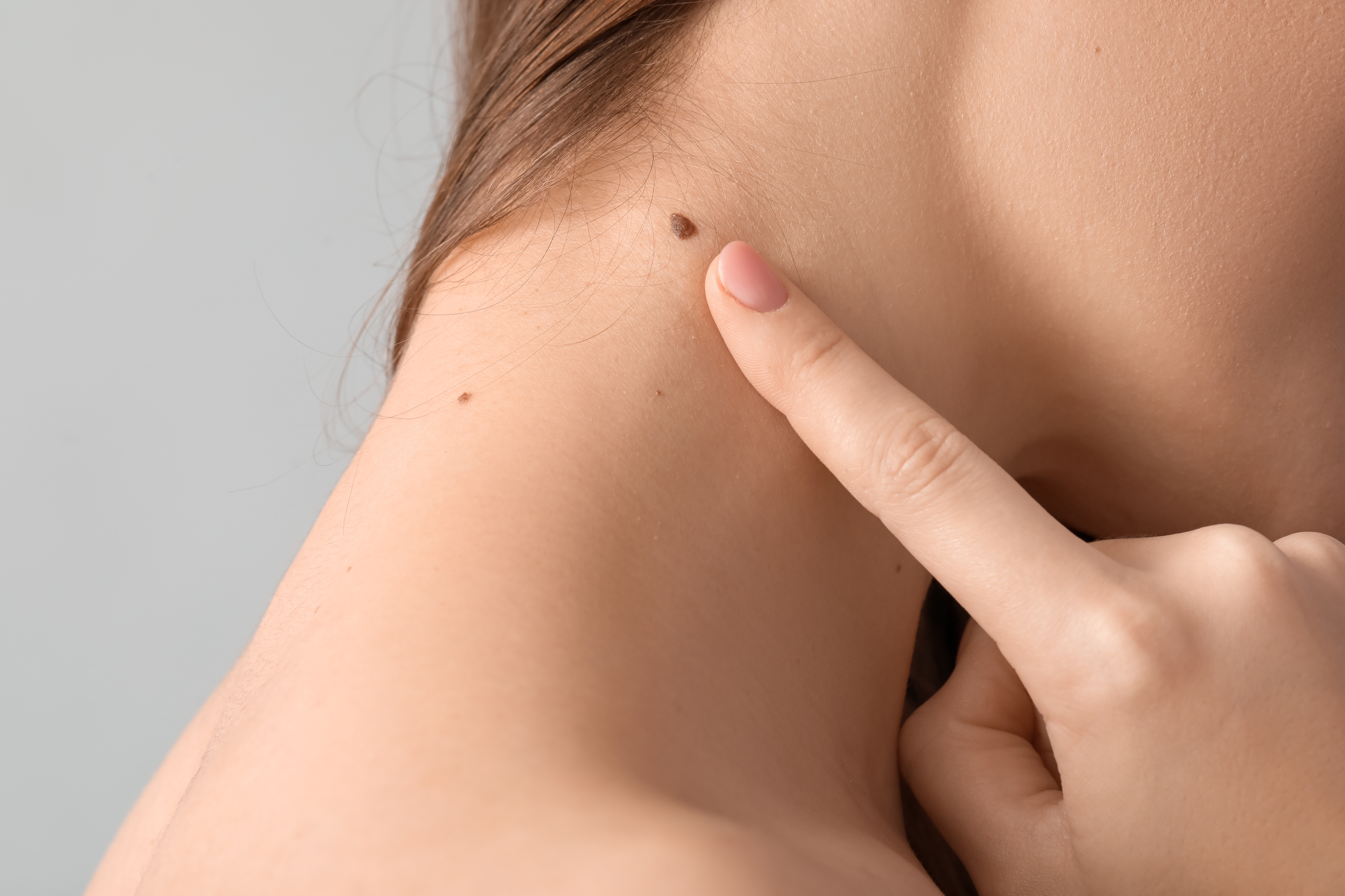 El dolor o la picazón pueden ser señales de cáncer en la piel.