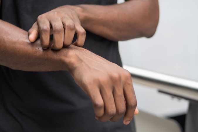 El eczema puede generar más ardor y picazón en pieles oscuras.