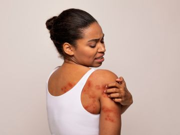 El eczema puede ser más dolores en perlas de piel negra.
