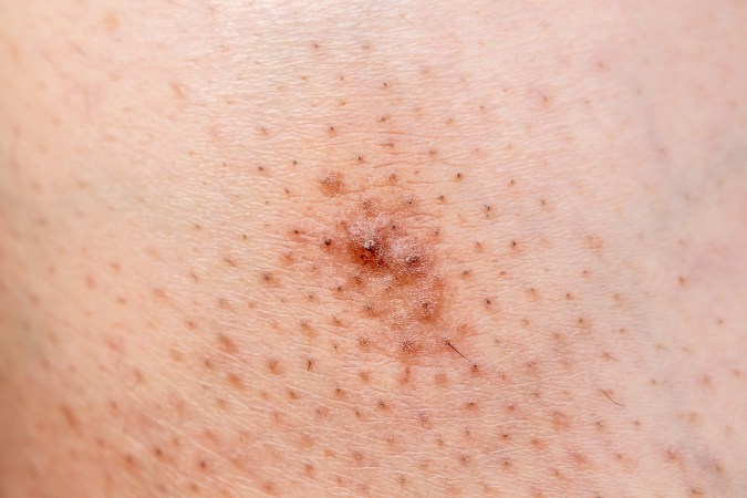 Exfolia tu piel para evitar los vellos encarnados.