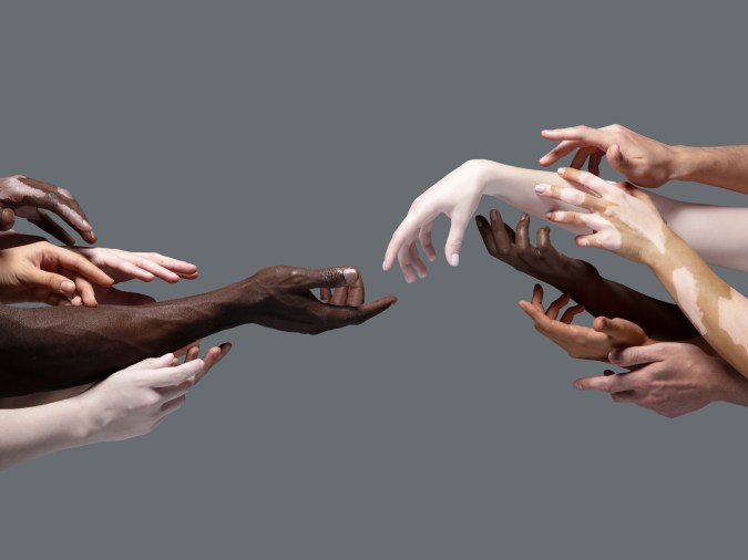 El vitiligo puede generar más quemaduras ante la exposición a los rayos solares.