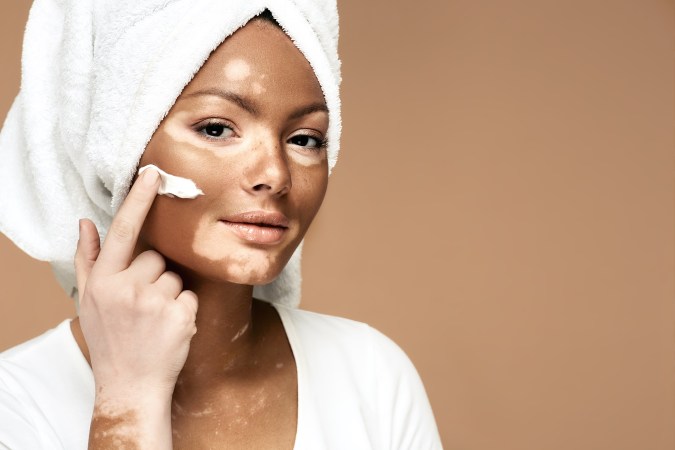 La piel con vitiligo debe hidratarse constantemente.